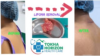 lipoma removal of nape of neck  dr bijay  tokha horizon [upl. by Kos]