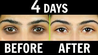 How to Remove Dark Circles Naturally in 4 Days 100 Results  Anaysa [upl. by Ettesil]