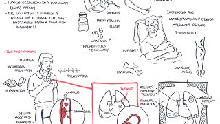 Pulmonary Embolism  Overview [upl. by Ylebmik]