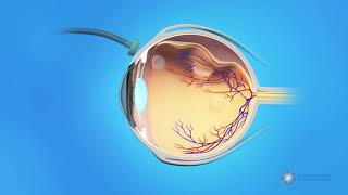 Vitrectomy Surgery for Detached Retina [upl. by Sims639]