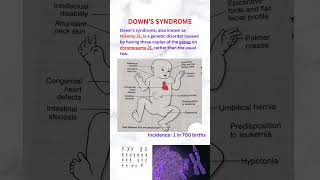 Down syndrome neet usmle pathologyacademy draditikumar [upl. by Foskett58]