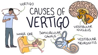 quotVertigo Explained Causes and Remedies by Dr Anjali Patel  चक्कर आने का कारण और उपायquot [upl. by Eadith228]