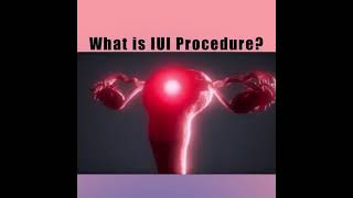 Intrauterine Insemination IUI for Pregnancy [upl. by Holden]