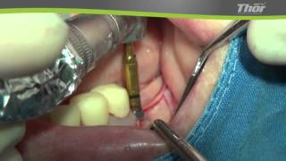 AnyRidge Ridge split surgery 4 utilizing Thor piezo machine [upl. by Aida]