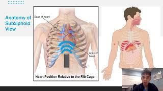 eFAST for EMS Appendix G Subxiphoid Pericardial View [upl. by Nilra]