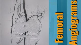 Interventional Angiogram of Lower extremity [upl. by Yddet]