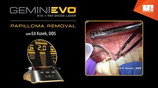 Papilloma Removal  Gemini™ EVO clinical cases [upl. by Wieren]