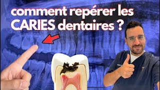 Apprendre à REPÉRER une CARIE DENTAIRE  Comprendre ensemble en 2min [upl. by Dranoel]