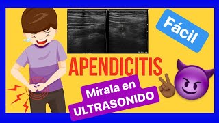 Apendicitis síntomas y ULTRASONIDO ✅ [upl. by Euqinom]