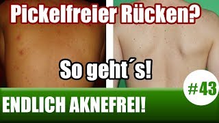 Pickel auf dem Rücken schnell loswerden Was tun Ursachen amp Lösungen ENDLICH AKNEFREI 43 [upl. by Edyth282]