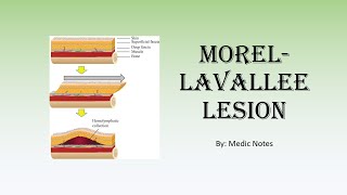 Morellavallee lesion  causes signs and symptoms investigation treatment [upl. by Anaynek]