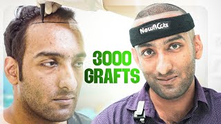 Hair Line Transplant  3000 Grafts  Hair Transplant Kolkata  New Roots [upl. by Stefa]