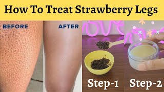 How To Treat Strawberry Legs At HomeIngrown Hair RemovalDos amp Donts To Treat Strawberry Skin [upl. by Revned]