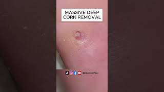 MASSIVE DEEP CORN REMOVAL BY MISS FOOT FIXER [upl. by Yetsirhc]