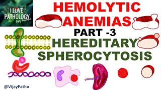 Hemolytic Anemias Part 3 HEREDITARY SPHEROCYTOSIS [upl. by Celinka]