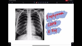 Chest xray of EmphysemaCOPD chestxray xraytutorial emphysema imaging radiology [upl. by Datha]