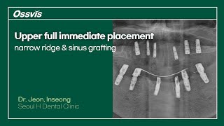 Clinical Case Upper full immediate placement on narrow ridge amp sinus grafting [upl. by Elnora198]