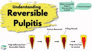 Reversible Pulpitis  Causes Diagnosis and Treatment  Endodontics [upl. by Bernete]