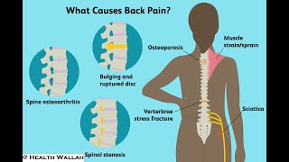 Back Pain I Lower back pain Pain or ache in the lower region of the back varying in intensity [upl. by Alo]