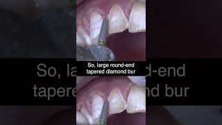 Prepping ANTERIOR Teeth with Enamel Hypoplasia  Ep 2 dentalshorts [upl. by Weinrich125]