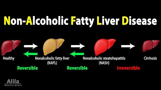 Nonalcoholic Fatty Liver Disease NAFLD Animation [upl. by Memory917]