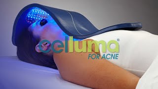 Celluma AntiAcne Light Therapy Treatment Featured in Dermascopes Tools of Skin Care Experts [upl. by Enyal151]