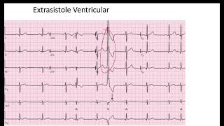 Comparación Extrasistole Auricular vs Ventricular EKG [upl. by Eslek]