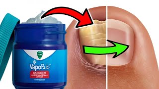 HOW TO USE VICKS VAPORUB TO TREAT TOENAIL FUNGUS [upl. by Hploda117]