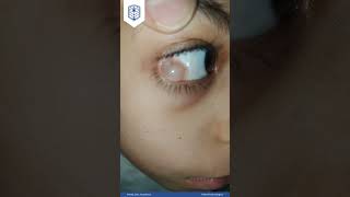 Educational Video 22 Conjunctival cyst by AEA [upl. by Yvaht]