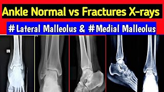 Ankle Fracture Xrays  Fracture Medial  Lateral  Posterior amp Both Malleolus  UdayXRay [upl. by Wey169]