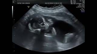 Ultrasound for pregnancy gyne obs ultrasound [upl. by Rue]