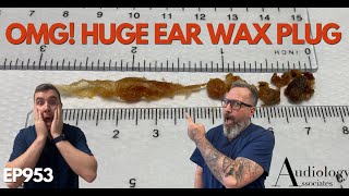 OMG HUGE EAR WAX PLUG REMOVED  EP953 [upl. by Codee]