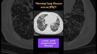 Fibrosing Lung Diseases seen on HRCT Differential Diagnosis UIP NSIP DIP shorts [upl. by Mohammad64]