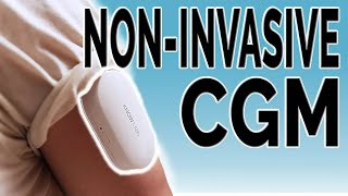 Are NonInvasive CGMs the Future [upl. by Keith164]