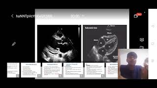 Pericardial disease Basic session 1 [upl. by Htes800]