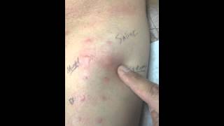 Final allergy skin test [upl. by Hardi]