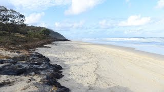 Suspected Irukandji jellyfish sting on Qlds Fraser Island [upl. by Adnalahs]