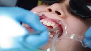 Braces Putting Braces On Bonding Procedure  Aura Orthodontics [upl. by Grimona]