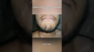 6 MONTH  Beard Journey Update [upl. by Aydan]