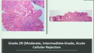 Endomyocardial BiopsyWhen  How and What to see  Dr Mukul Vij [upl. by Losse754]