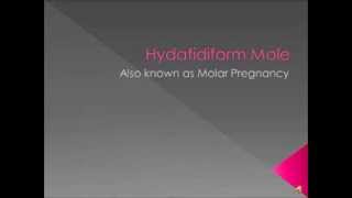 Hydatidiform Mole Video [upl. by Atekram]