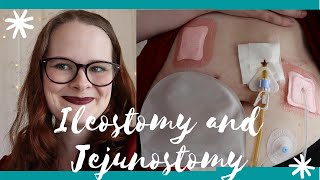 I had Ileostomy and Jejunostomy Surgery During a Pandemic [upl. by Vince]