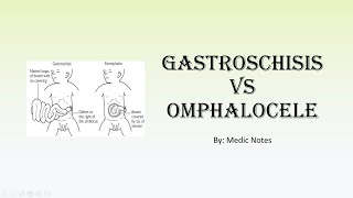 Gastroschisis vs omphalocele [upl. by Win835]