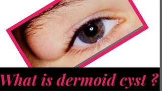 Dermoid cyst [upl. by Aileon]