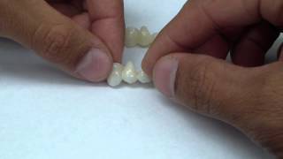 Emax and Zirconia FDPs Bridge [upl. by Enaillil]