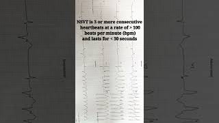 NSVT ECG interpretation made easy  Non Sustained Ventricular Tachycardia shortsfeed shorts ecg [upl. by Nylzaj]