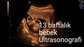 13 haftalık gebelikte ultrasonografi  bebeğin organları plasenta ve amniyos sıvısı [upl. by Sibie]