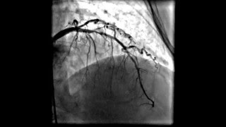 Acute anterior wall myocardial infarction [upl. by Anawaj]