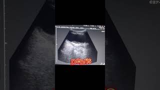 Cystitis  Wall Calcifications  Thick wall Bladder  Debris in Bladder on Ultrasound [upl. by Ladiv]