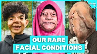 9 Of The Rarest Facial Conditions In The World  BORN DIFFERENT [upl. by Eno]